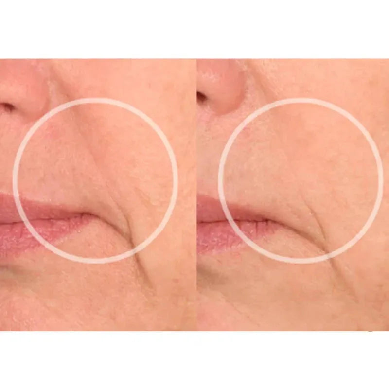 Anti-Wrinkle Smile Lines Pad – Smooth, Firm & Rejuvenate
